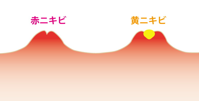 ニキビ跡-できやすいのは赤と黄